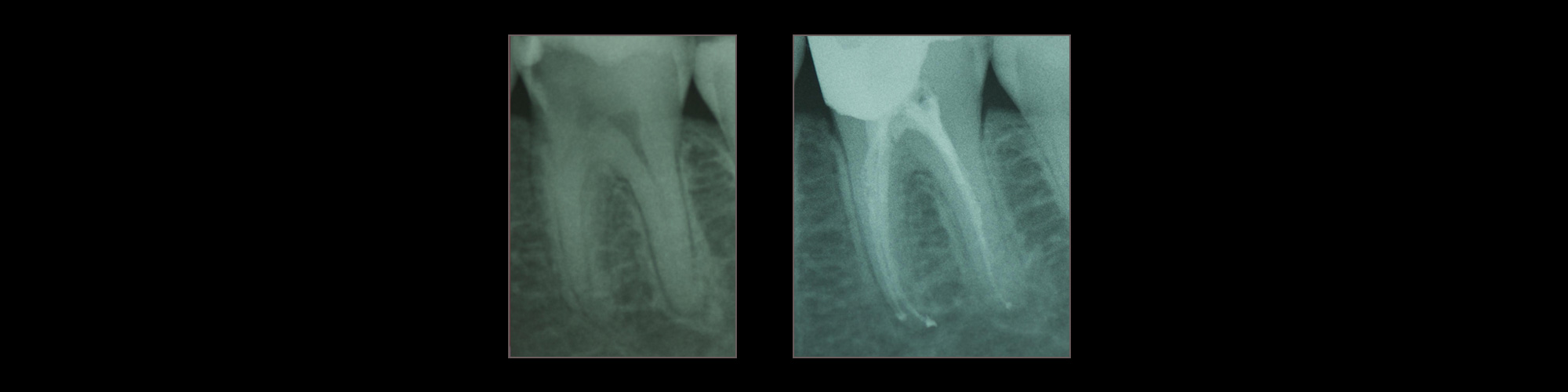 endodonzia